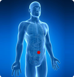 Umbilical Hernia