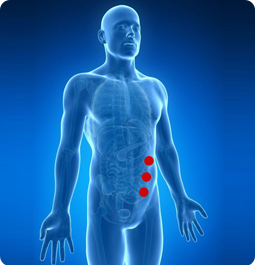 Surgical Site Hernia